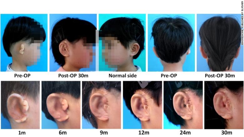 Выращеные в напечатанных 3D-формах ушные раковины, успешно привиты 5 детям